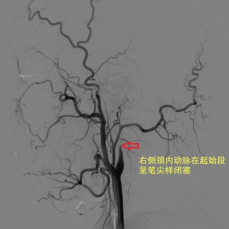 肩颈按摩竟致急性脑梗死！年轻人更容易中招