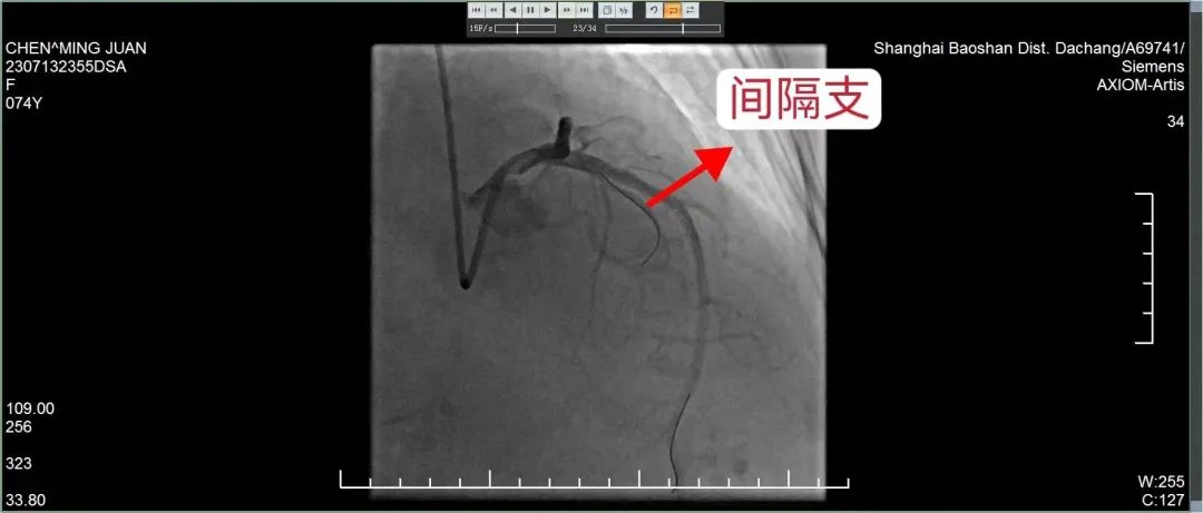 上海仁济医院宝山分院心内科成功完成院内首例「梗阻性肥厚型心肌病无水酒精消融」手术