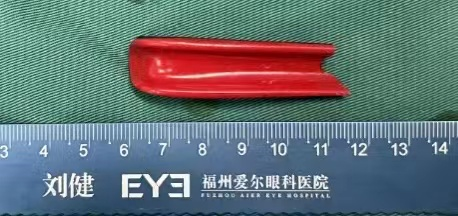 福州爱尔眼科医院刘健主任携团队借道鼻腔智取入眼异物，挽救患者视力