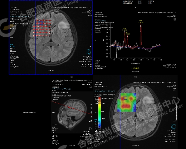 【高尚病例】头颅 MR 诊断局灶性皮层发育不良（FCD）一例
