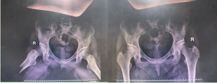 有一种腿疼因髋关节发育不良？从抱娃开始就能预防