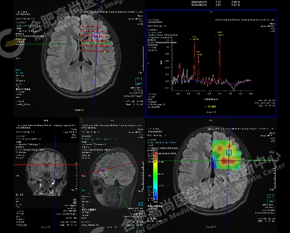 【高尚病例】头颅 MR 诊断局灶性皮层发育不良（FCD）一例