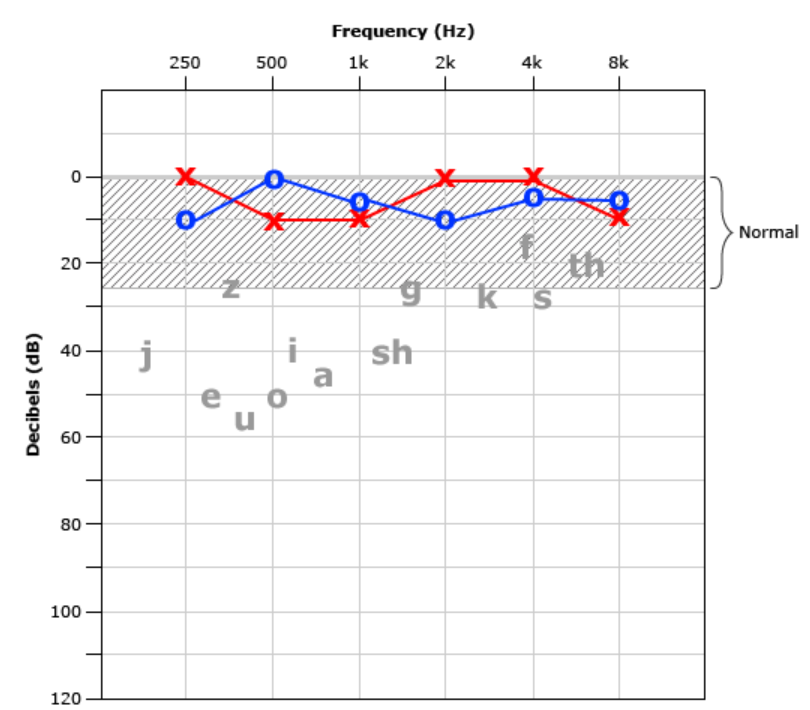 仁树医院广州院区「不容忽视的老年性聋」