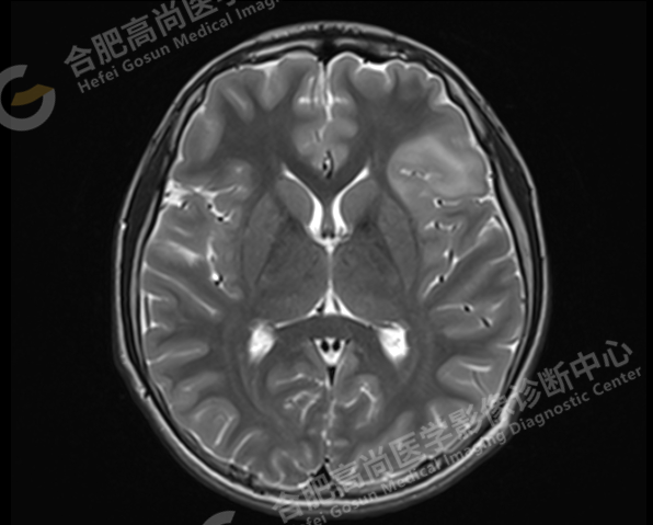 【高尚病例】头颅 MR 诊断局灶性皮层发育不良（FCD）一例