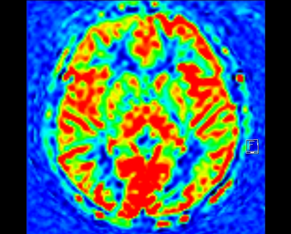 【高尚病例】头颅 MR 诊断局灶性皮层发育不良（FCD）一例