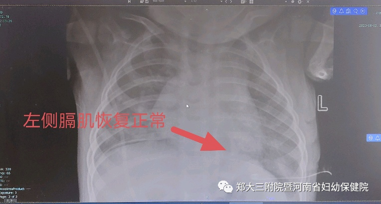 罕见！胃体上下颠倒，挤走了心脏