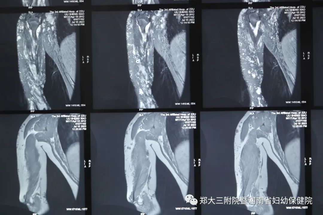 郑州大学第三附属医院助力救治 11 岁男孩重症静脉畸形