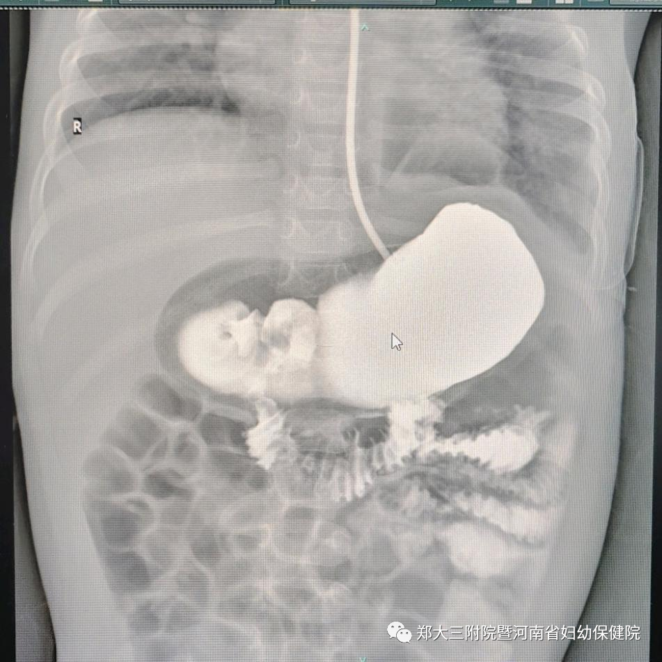 罕见！胃体上下颠倒，挤走了心脏