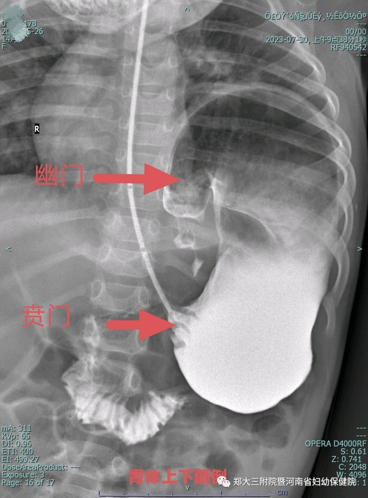 罕见！胃体上下颠倒，挤走了心脏