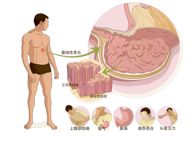 疾病模型|慢性萎缩性胃炎（CAG）与胃癌（GC）上