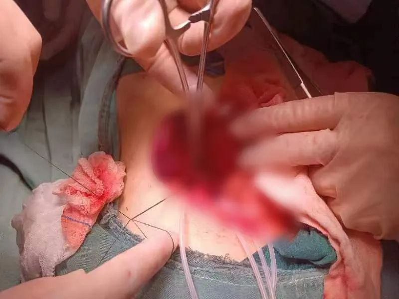 江西省儿童医院成功实施精准「保脾」的脾肿瘤切除术