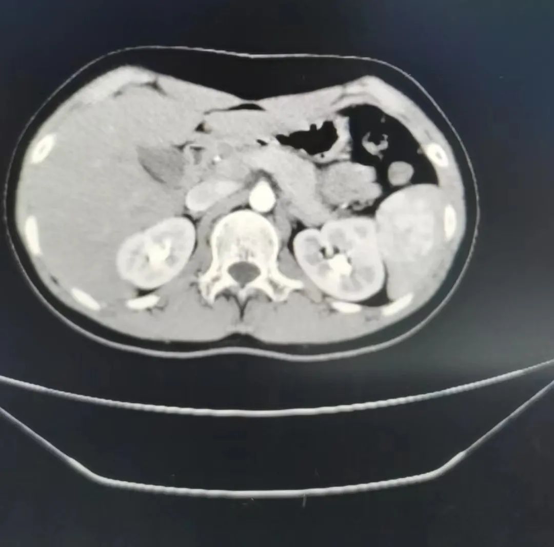 江西省儿童医院成功实施精准「保脾」的脾肿瘤切除术