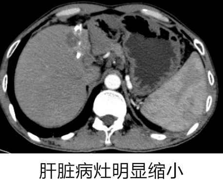 罗湖医院普外科专家团队为晚期肝癌患者开展综合治疗探索