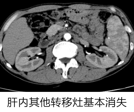 罗湖医院普外科专家团队为晚期肝癌患者开展综合治疗探索