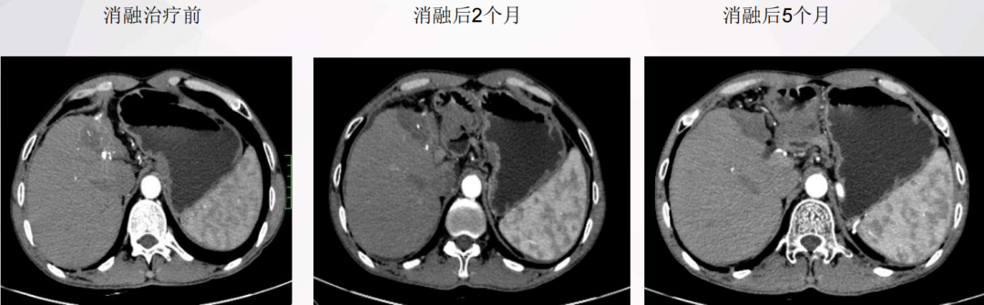 罗湖医院普外科专家团队为晚期肝癌患者开展综合治疗探索