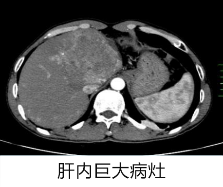 罗湖医院普外科专家团队为晚期肝癌患者开展综合治疗探索