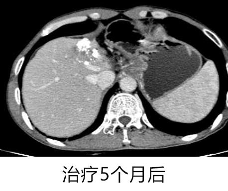 罗湖医院普外科专家团队为晚期肝癌患者开展综合治疗探索