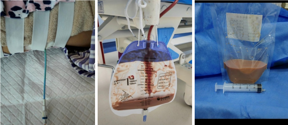 肾囊肿一个月由 4 cm 激增至 21 cm，西安高新医院成功为其穿刺引流