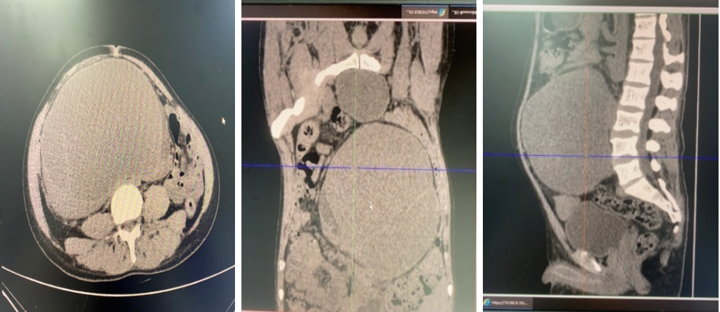 肾囊肿一个月由 4 cm 激增至 21 cm，西安高新医院成功为其穿刺引流