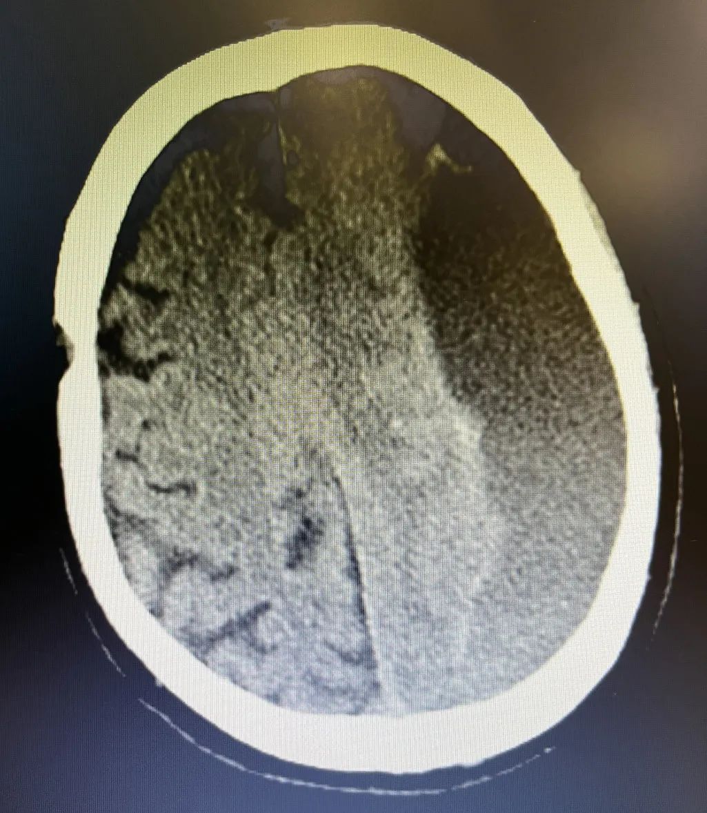 重庆松山医院神经疾病科助力 90 岁高龄脑出血患者恢复健康