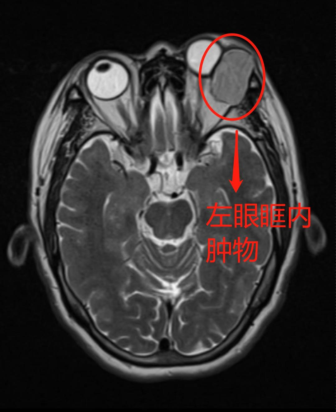眼眶内藏着比眼球还大的「肿瘤」！柳州市红十字会医院眼五病区妙手「拆弹」