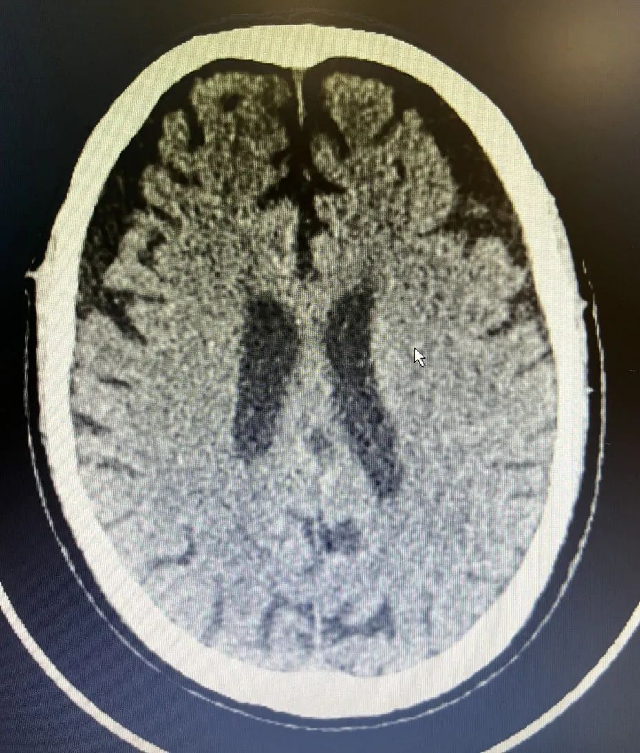 重庆松山医院神经疾病科助力 90 岁高龄脑出血患者恢复健康