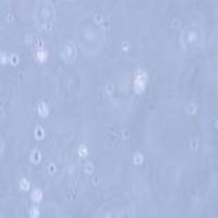 NK-92MI 人恶性非霍奇金淋巴瘤患者的自然杀伤细胞