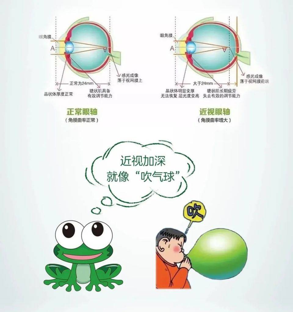 高度近视能做近视手术吗?武汉普瑞眼科医院关念主任在线讲解