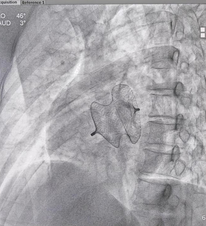 西藏阜康医院成功实施大房间隔缺损合并肺动脉高压介入封堵手术