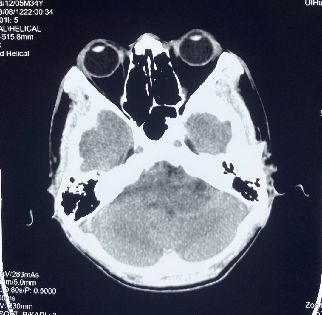 【高尚病例】听神经瘤 1 例