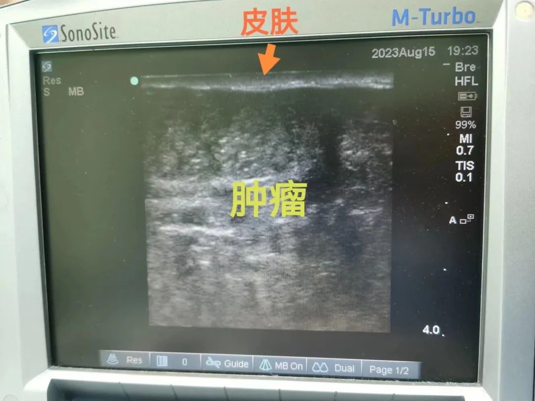 是发育还是怪病？12 岁少女一侧乳房疯狂生长！真相吓人...