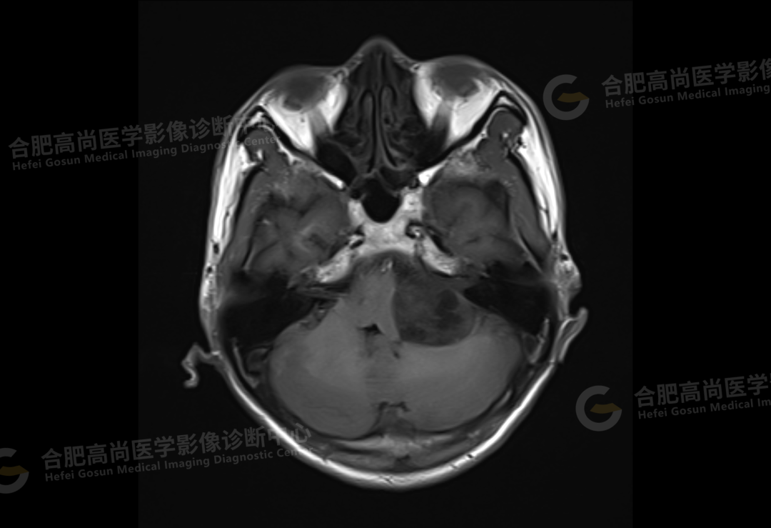 【高尚病例】听神经瘤 1 例