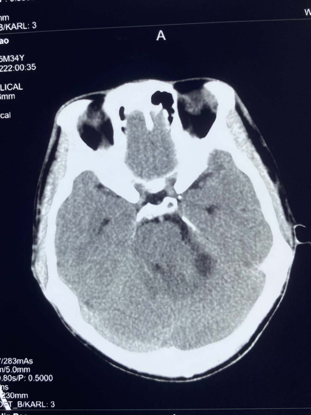 【高尚病例】听神经瘤 1 例