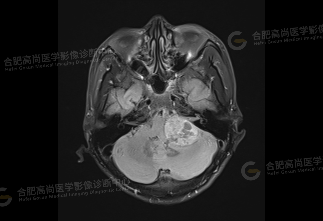 【高尚病例】听神经瘤 1 例