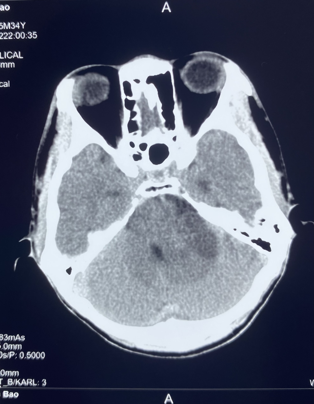 【高尚病例】听神经瘤 1 例