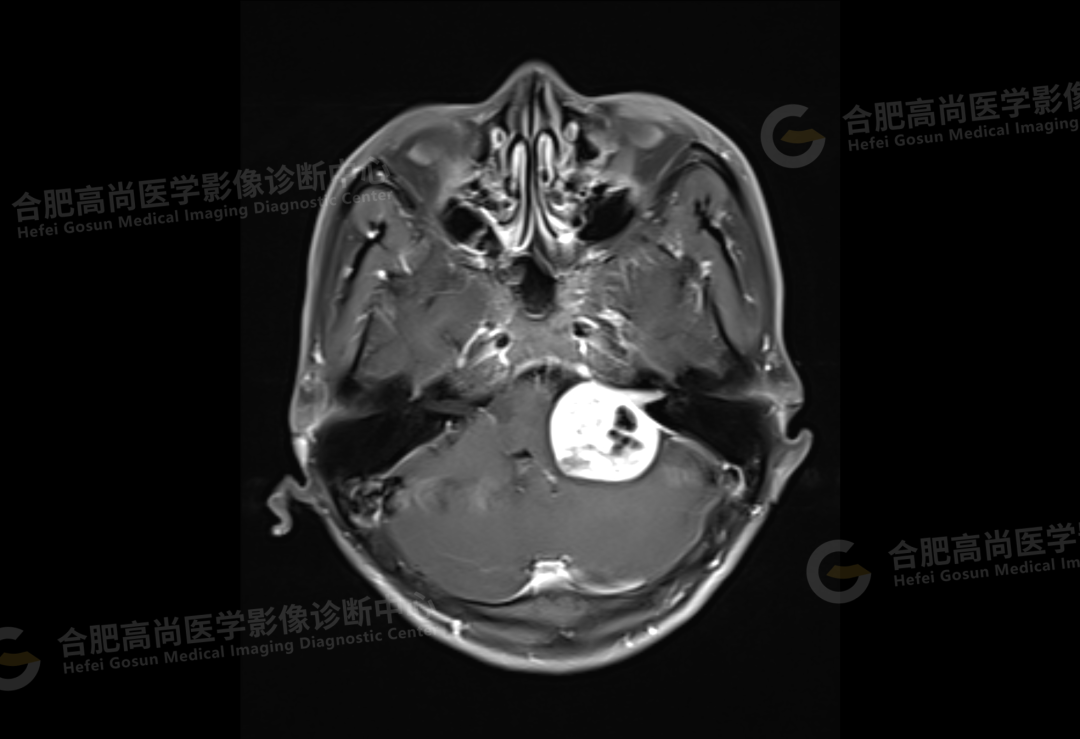 【高尚病例】听神经瘤 1 例