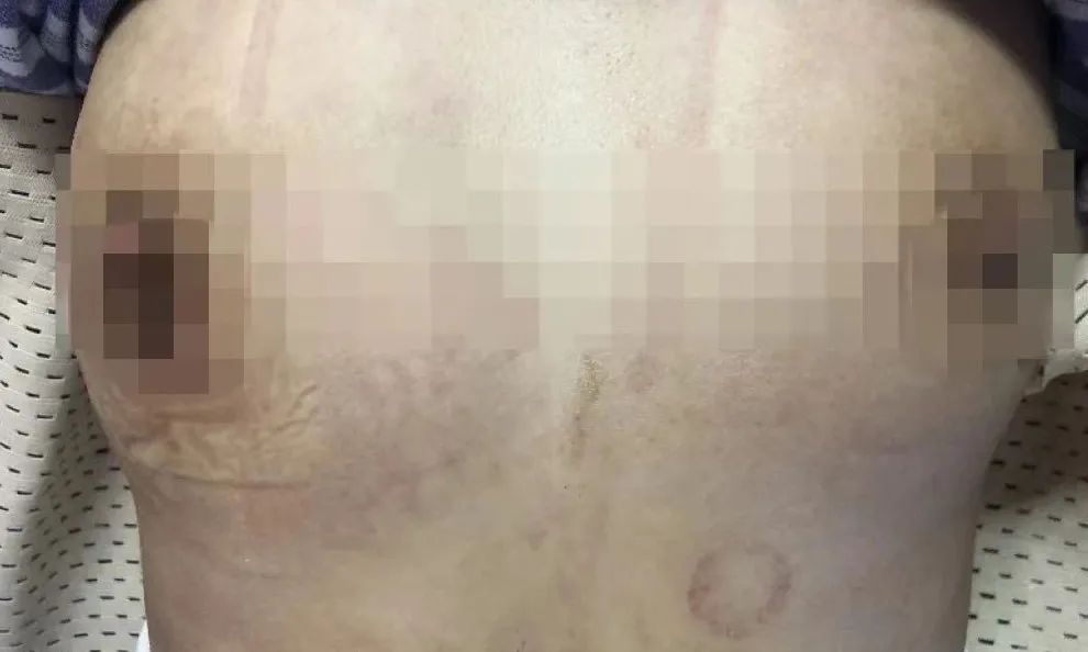 是发育还是怪病？12 岁少女一侧乳房疯狂生长！真相吓人...
