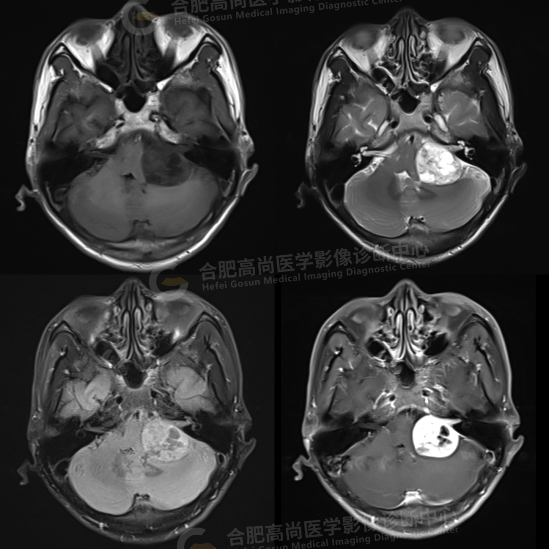 【高尚病例】听神经瘤 1 例