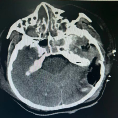 分秒必争 协同合作丨南京江北医院成功抢救重型颅脑损伤患者