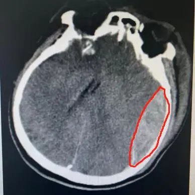 分秒必争 协同合作丨南京江北医院成功抢救重型颅脑损伤患者