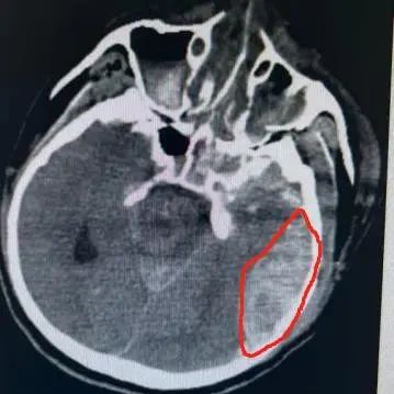 分秒必争 协同合作丨南京江北医院成功抢救重型颅脑损伤患者