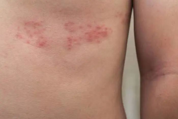 比生娃还痛的「蛇缠腰」 可防可治！