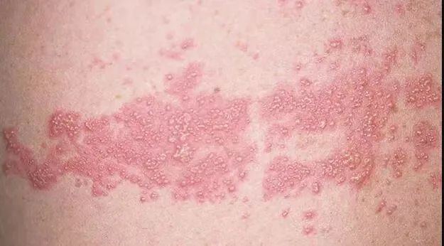 比生娃还痛的「蛇缠腰」 可防可治！