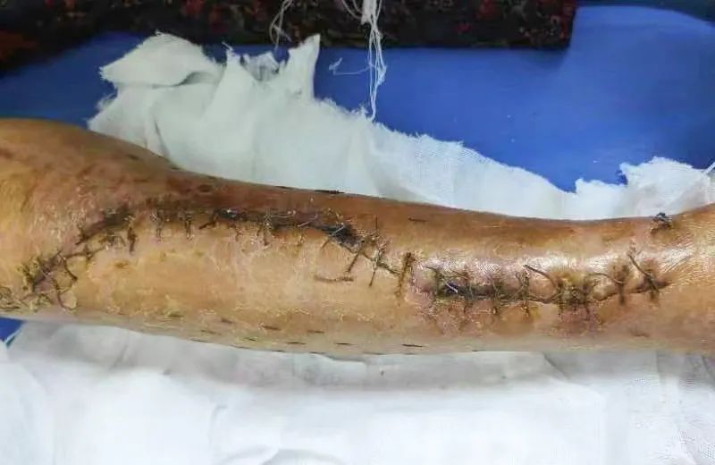 治疗 MRSA 感染，谨防血小板减少成为「绊脚石」