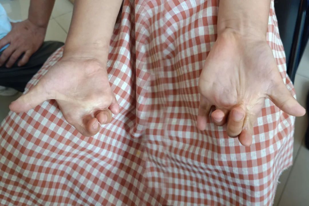 漳州正兴医院助力烫伤致残患者修复双手