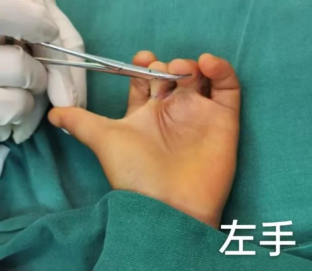 漳州正兴医院助力烫伤致残患者修复双手