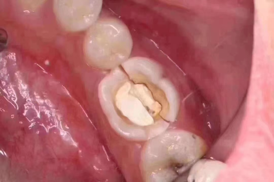 根管治疗是什么？有必要做吗？