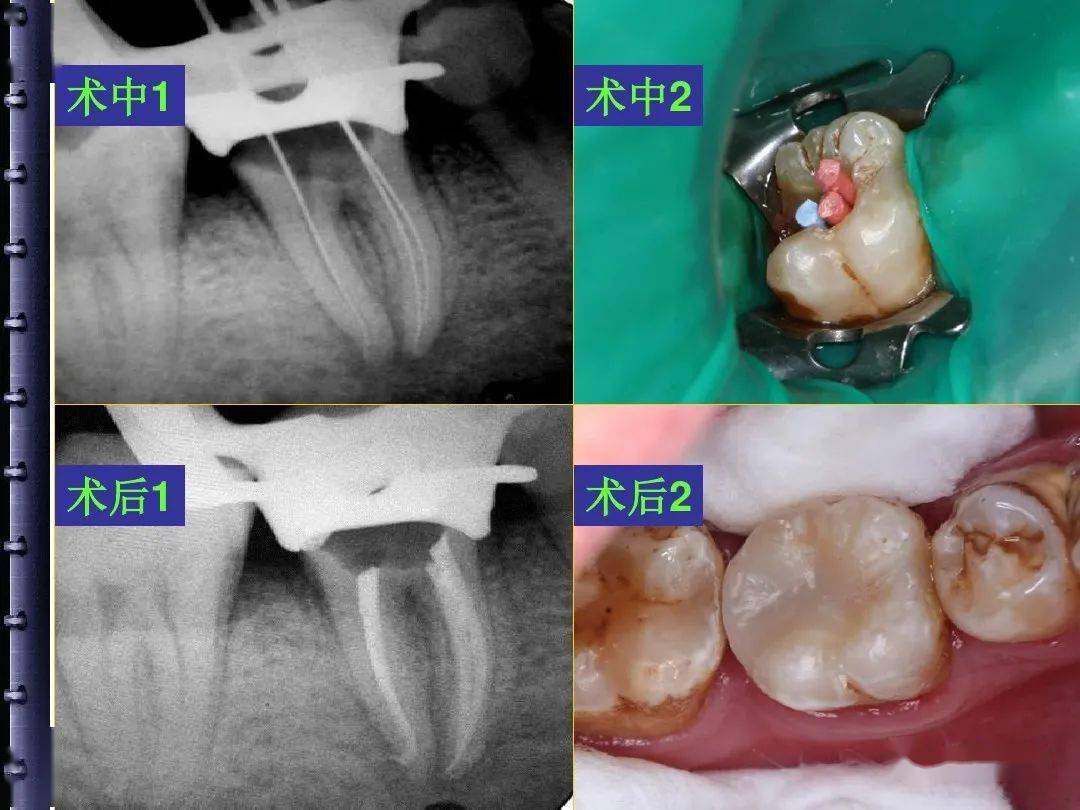 根管治疗是什么？有必要做吗？