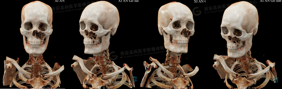 【高尚病例】腺样囊性癌