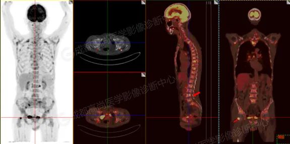 高尚病例】多发性骨髓瘤PET/CT 诊断及疗效评估-医院汇-丁香园